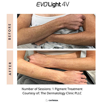 Benign Pigmented lesion
